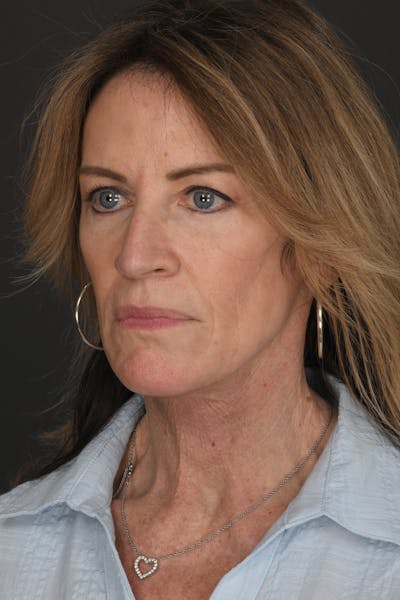 Composite Facelift Before & After Gallery - Patient 126674 - Image 2