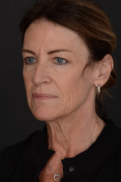 Composite Facelift Before & After Gallery - Patient 126674 - Image 1