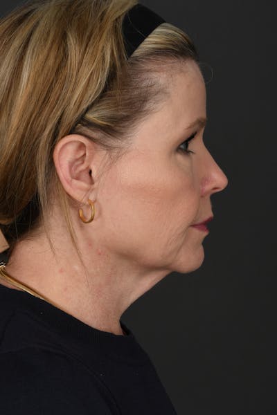 Neck Lift Before & After Gallery - Patient 121215 - Image 1