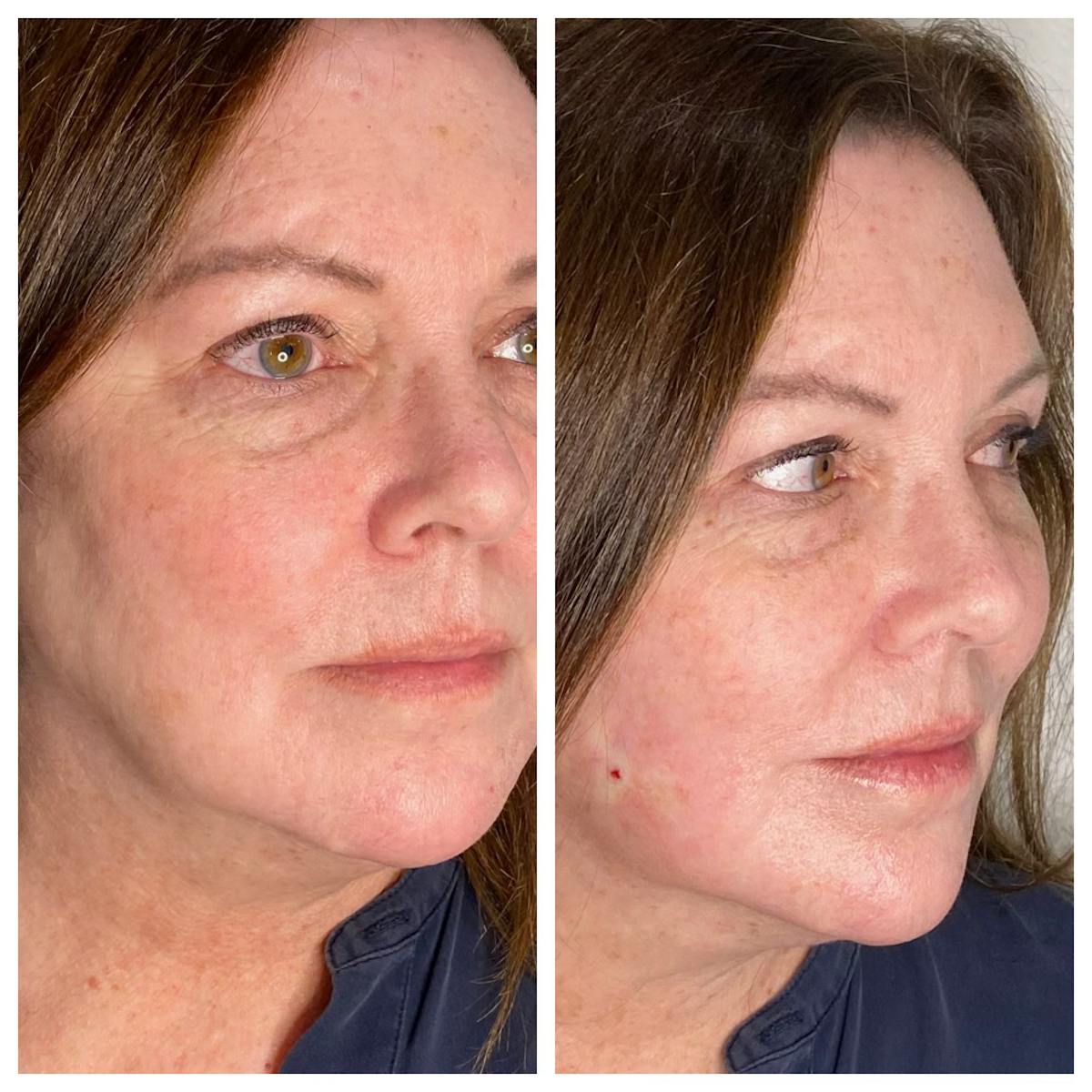 Ultherapy Before & After Gallery - Patient 133227596 - Image 1