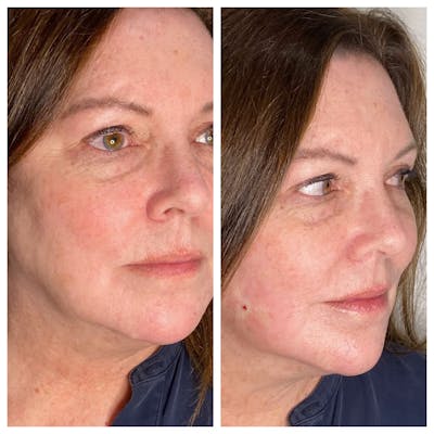 Ultherapy Before & After Gallery - Patient 133227596 - Image 1