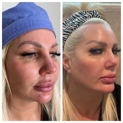 Ultherapy Before & After Gallery - Patient 133227606 - Image 1