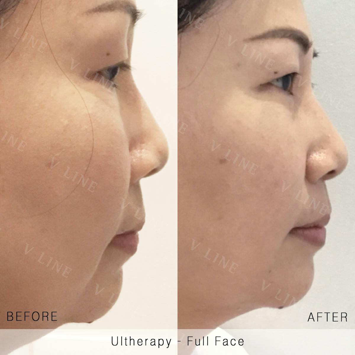 Ultherapy Before & After Gallery - Patient 133227589 - Image 1