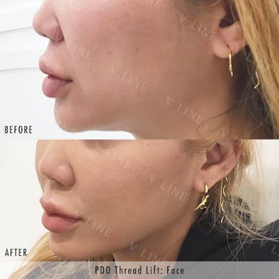 PDO Threads Before & After Gallery - Patient 133235957 - Image 1