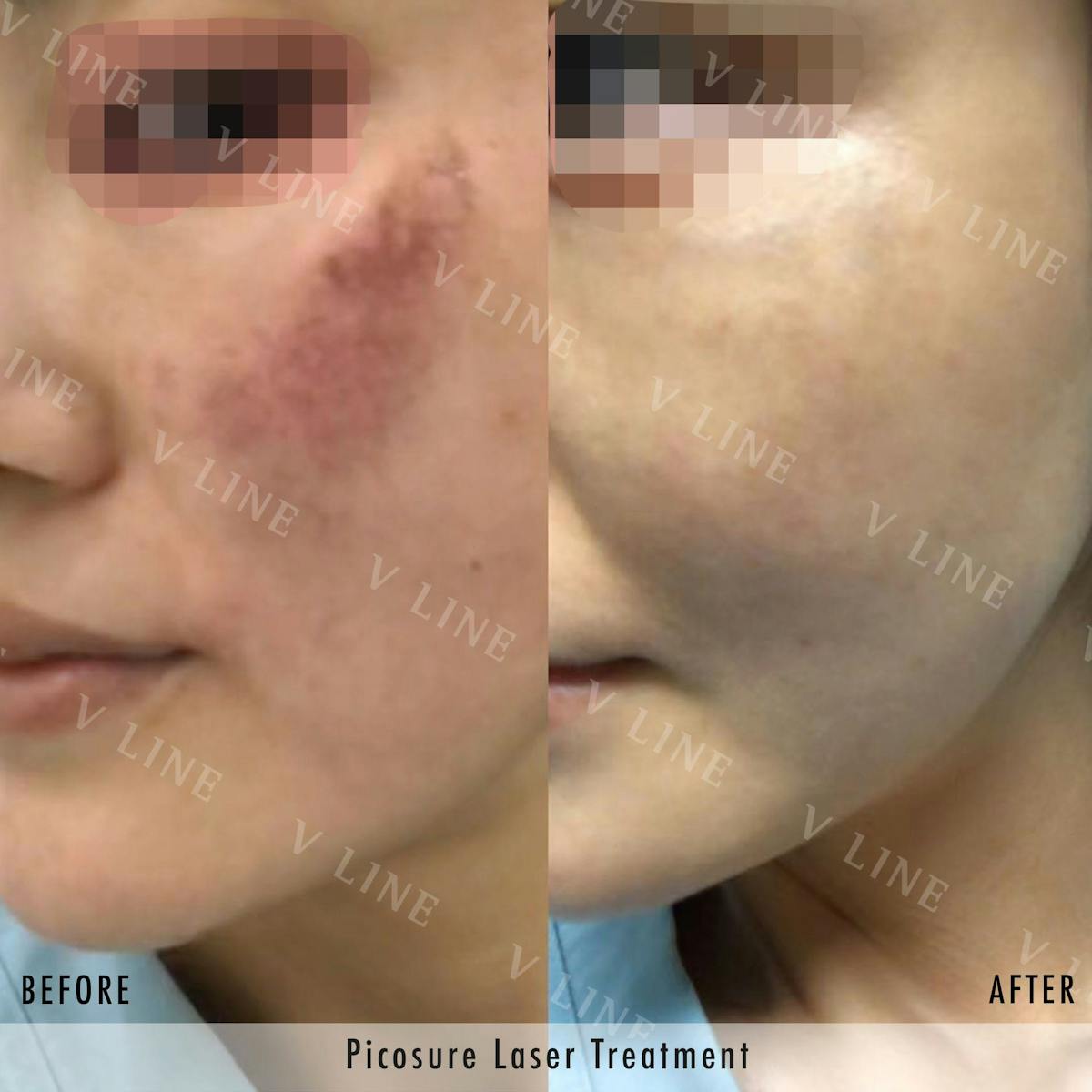 Picosure Before & After Gallery - Patient 133265013 - Image 1