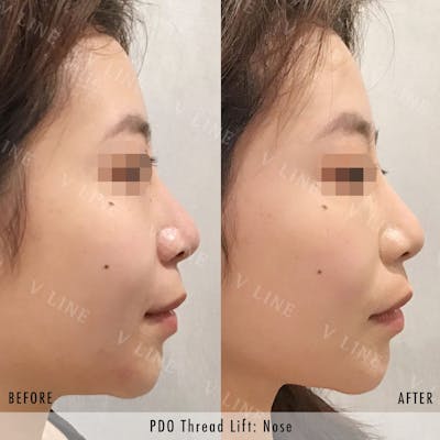 PDO Threads Before & After Gallery - Patient 133235960 - Image 1