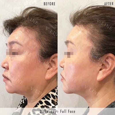 Ultherapy Before & After Gallery - Patient 133227592 - Image 1