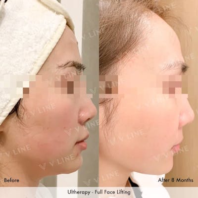 Ultherapy Before & After Gallery - Patient 133227595 - Image 1