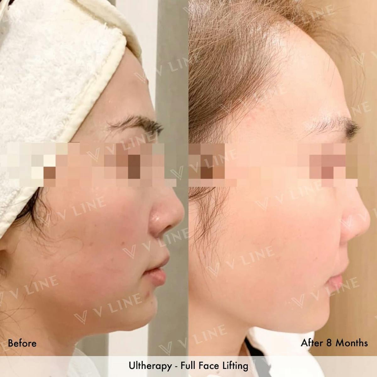 Ultherapy Before & After Gallery - Patient 133227595 - Image 1