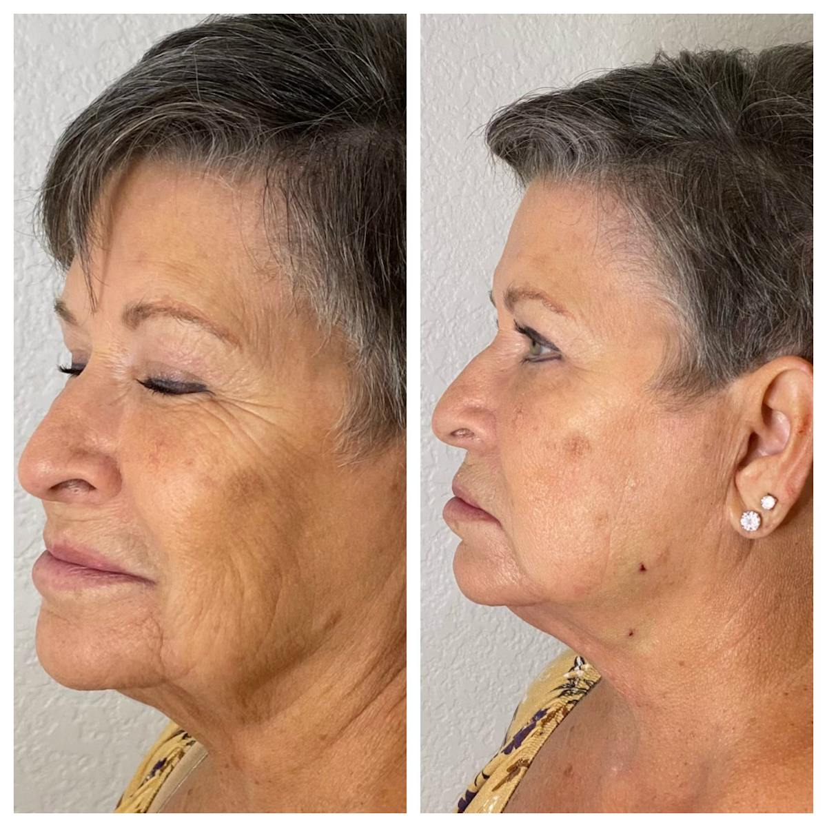 Ultherapy Before & After Gallery - Patient 133227601 - Image 1