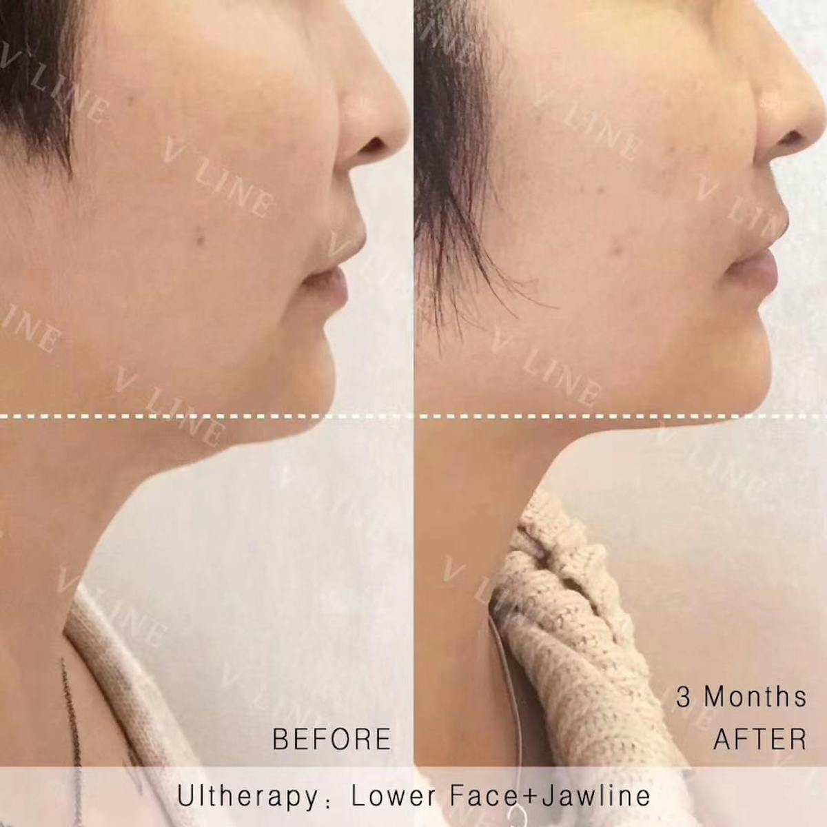 Ultherapy Before & After Gallery - Patient 133227598 - Image 1