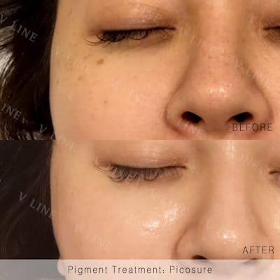 Picosure Before & After Gallery - Patient 133227435 - Image 1