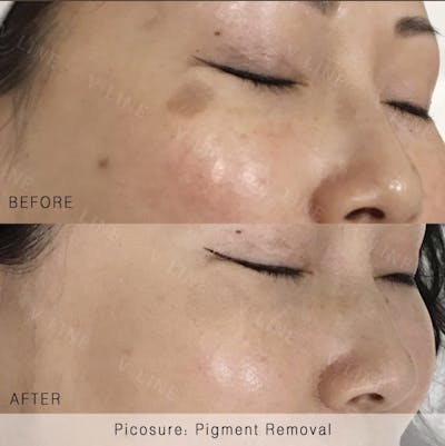Picosure Before & After Gallery - Patient 133227622 - Image 1