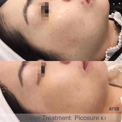 Picosure Before & After Gallery - Patient 133227624 - Image 1