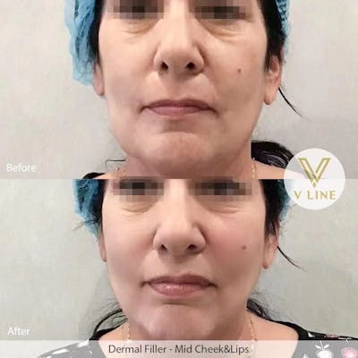 Dermal Fillers Before & After Gallery - Patient 133227506 - Image 1