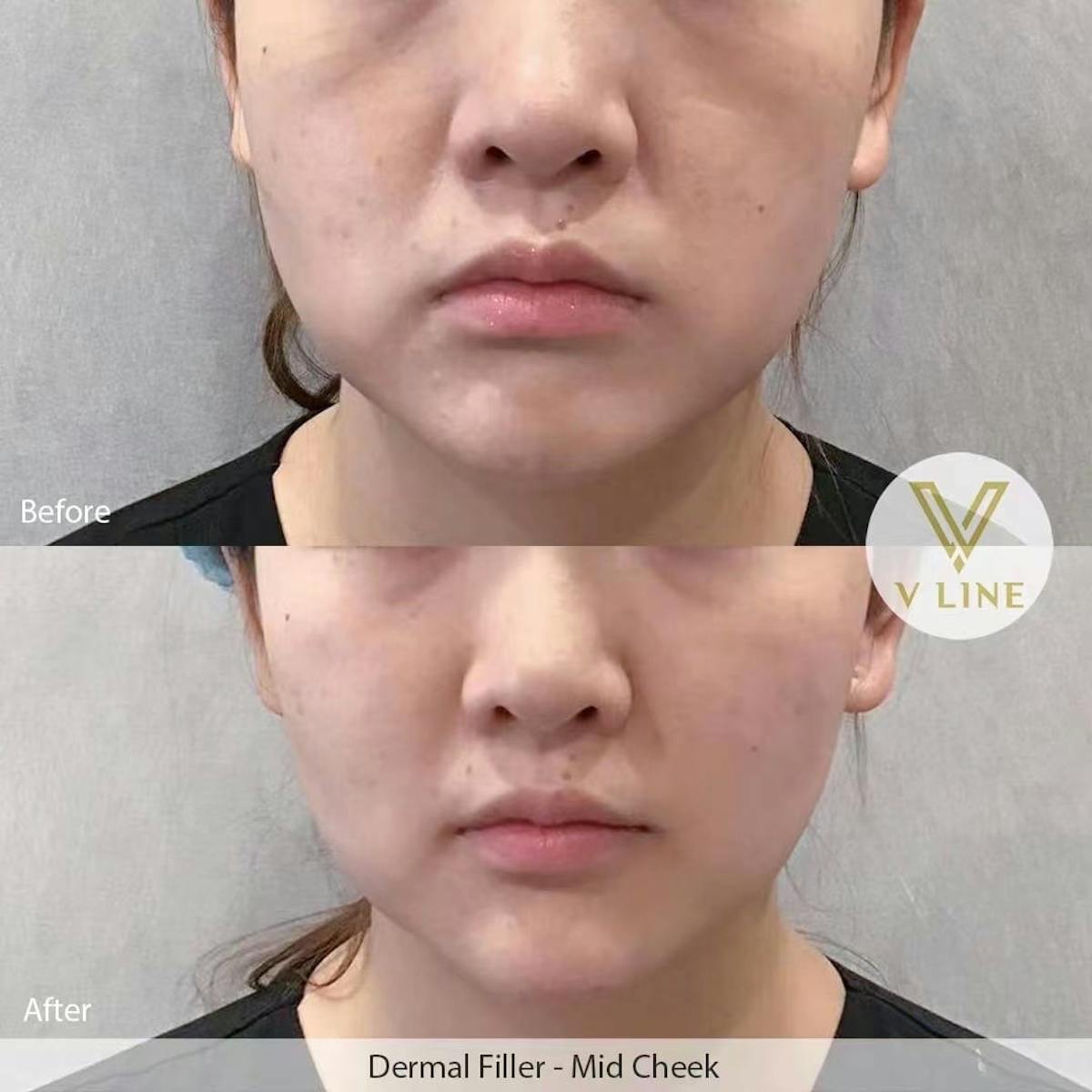 Dermal Fillers Before & After Gallery - Patient 133227498 - Image 1