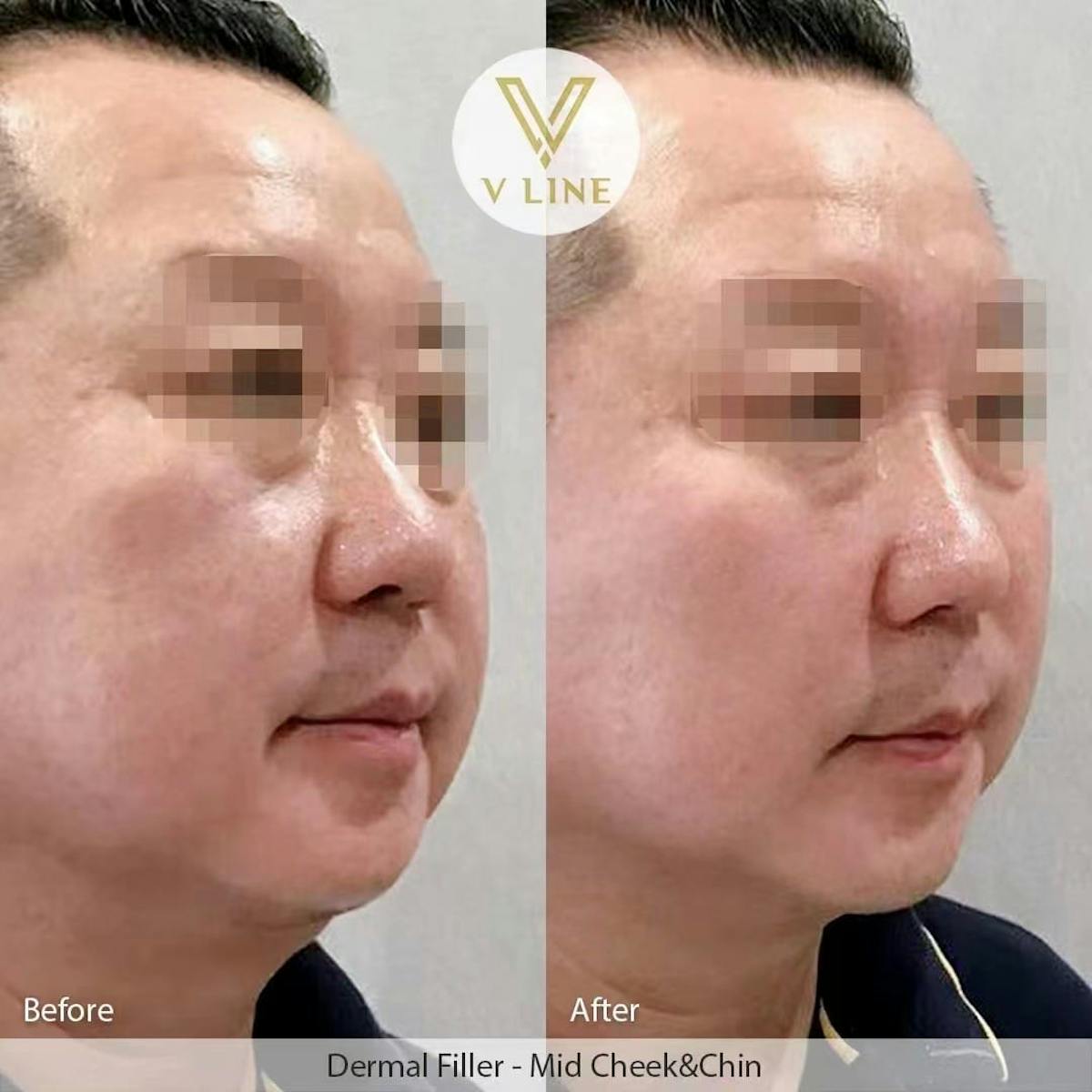 Dermal Fillers Before & After Gallery - Patient 133227513 - Image 1