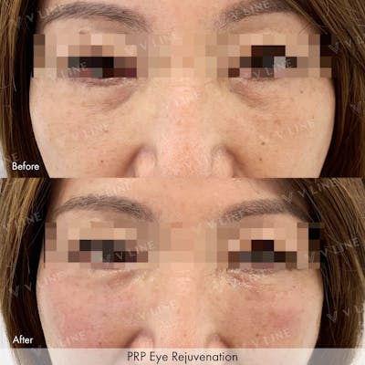 Platelet Rich Plasma Before & After Gallery - Patient 133235520 - Image 1