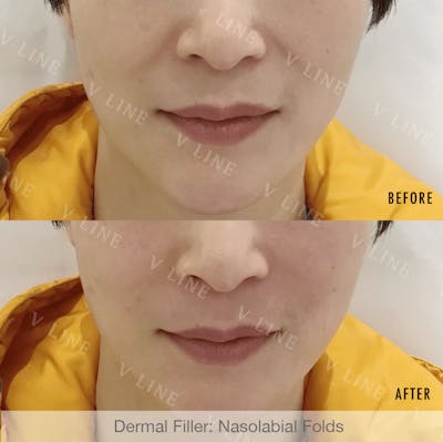 Dermal Fillers Before & After Gallery - Patient 133227479 - Image 1
