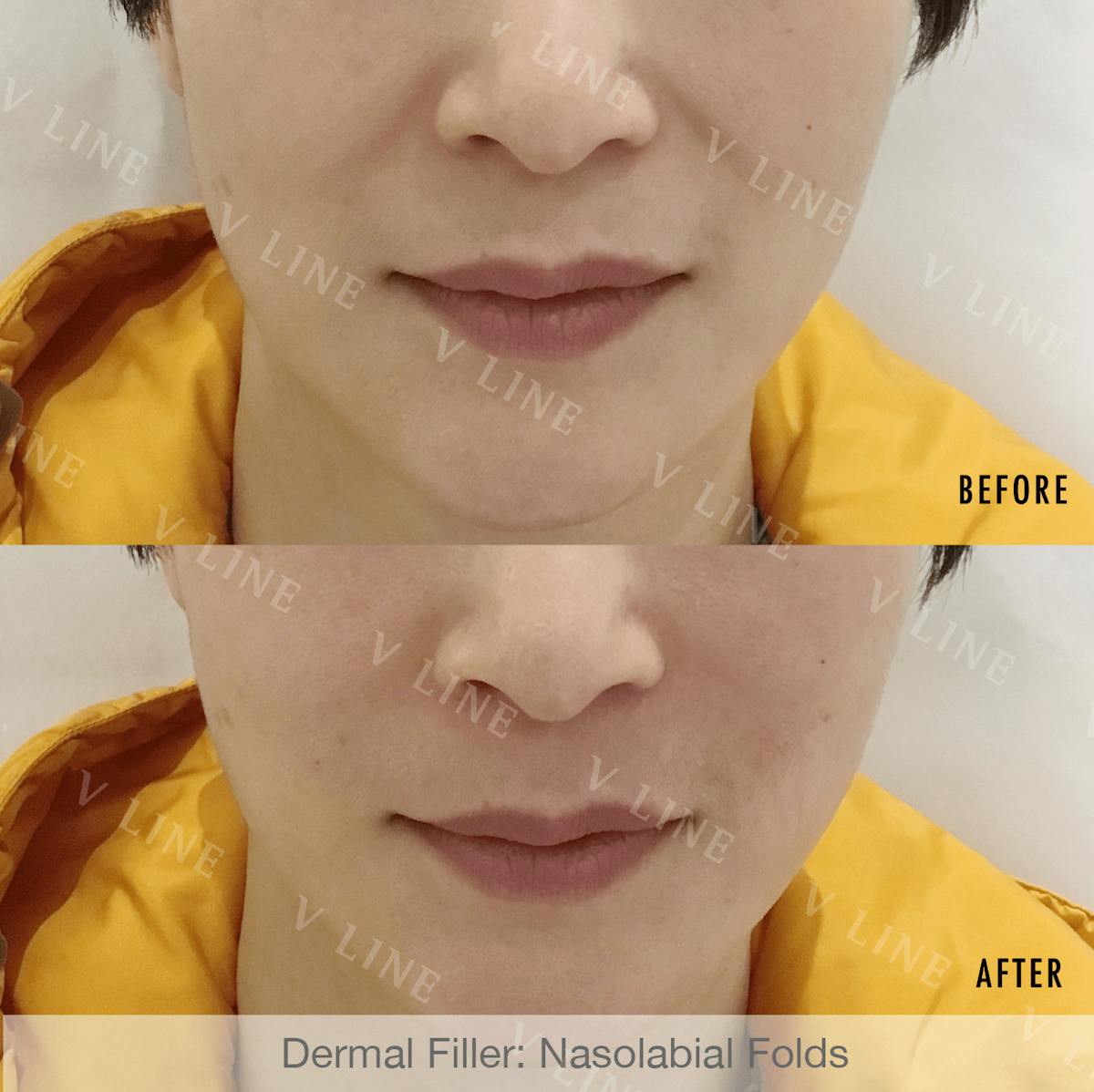 Dermal Fillers Before & After Gallery - Patient 133227479 - Image 1
