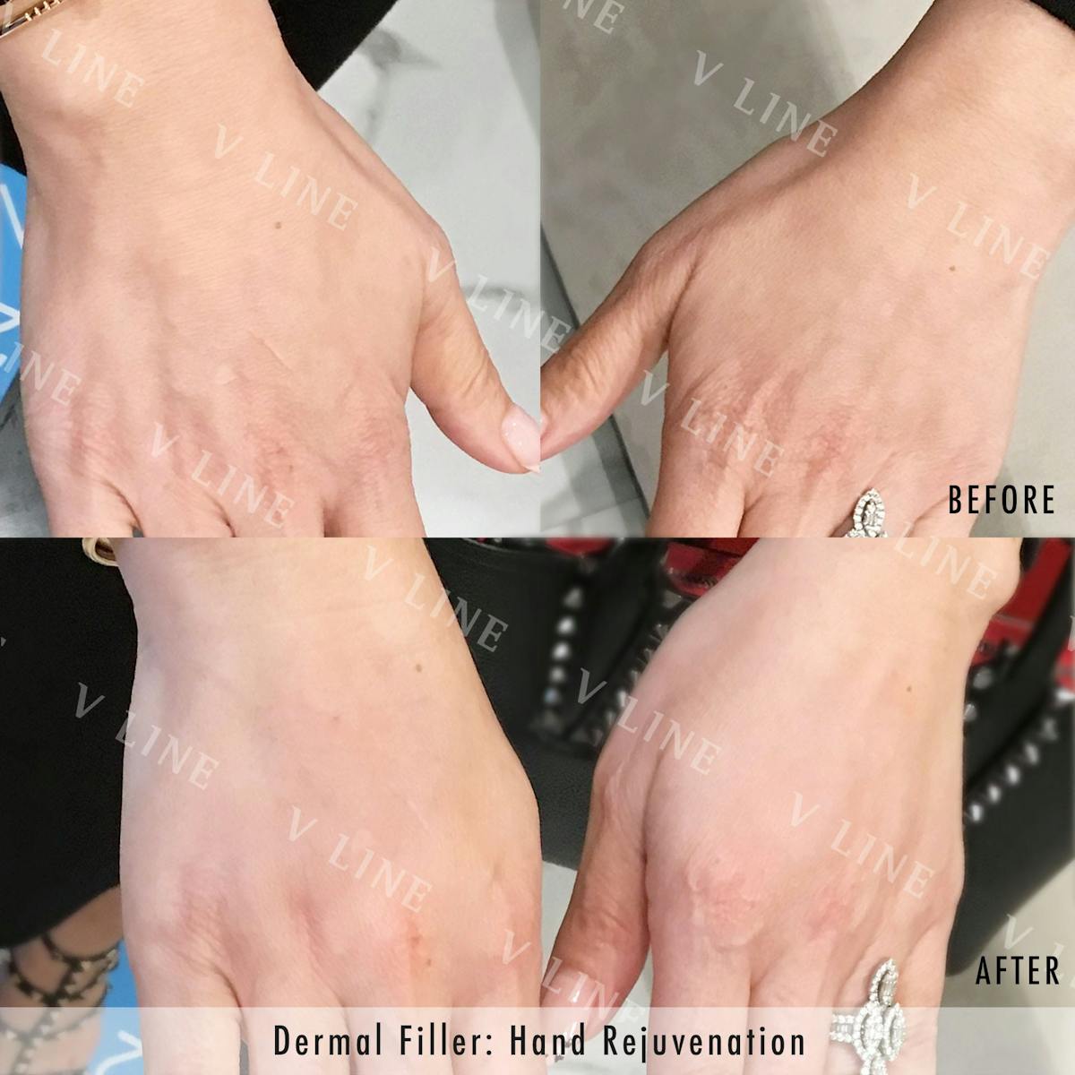 Dermal Fillers Before & After Gallery - Patient 133227491 - Image 1