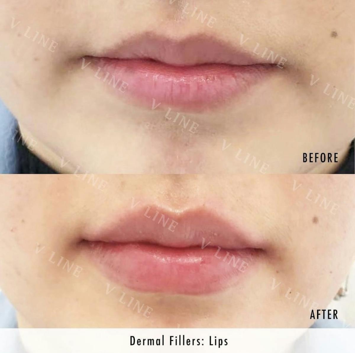 Dermal Fillers Before & After Gallery - Patient 133227486 - Image 1