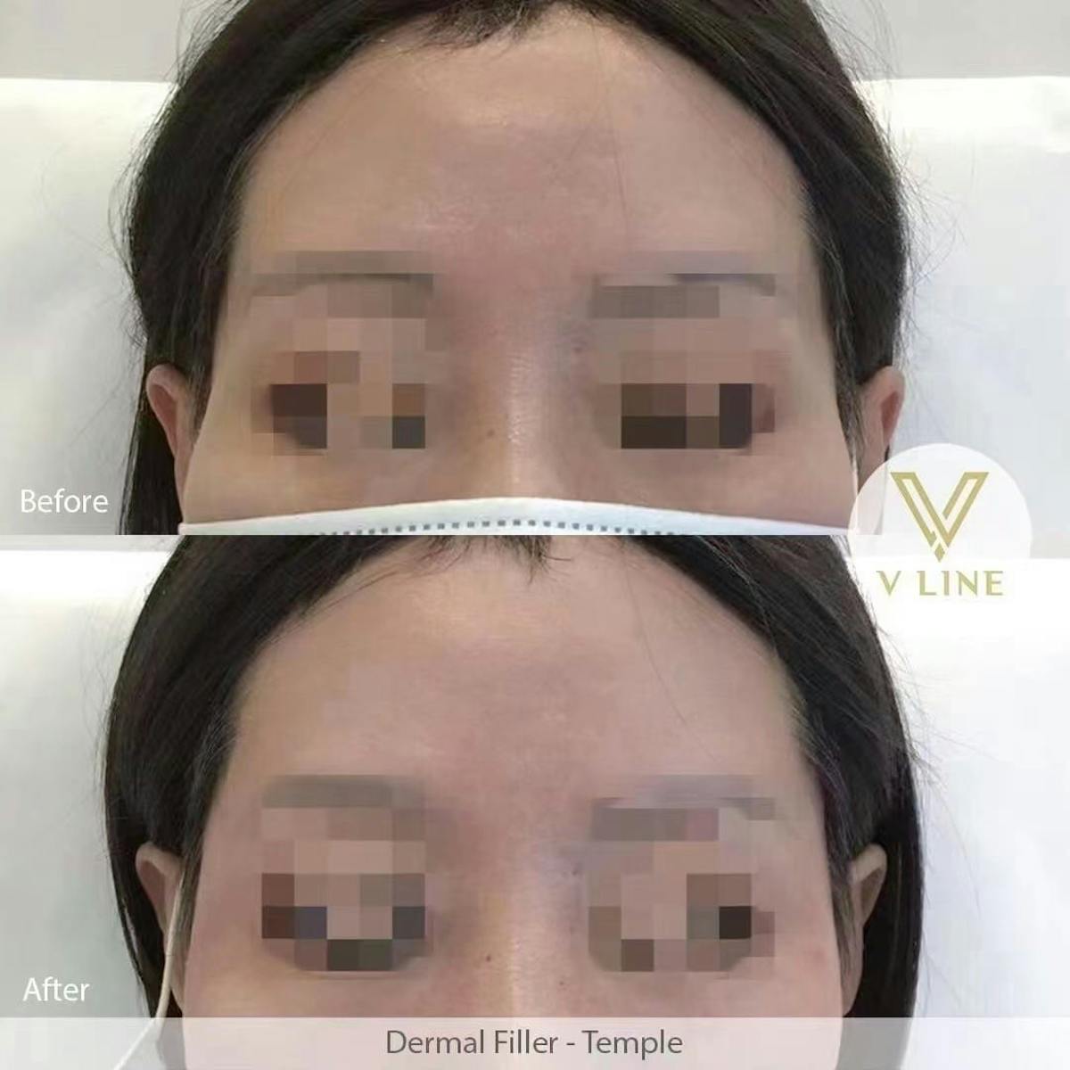 Dermal Fillers Before & After Gallery - Patient 133227502 - Image 1