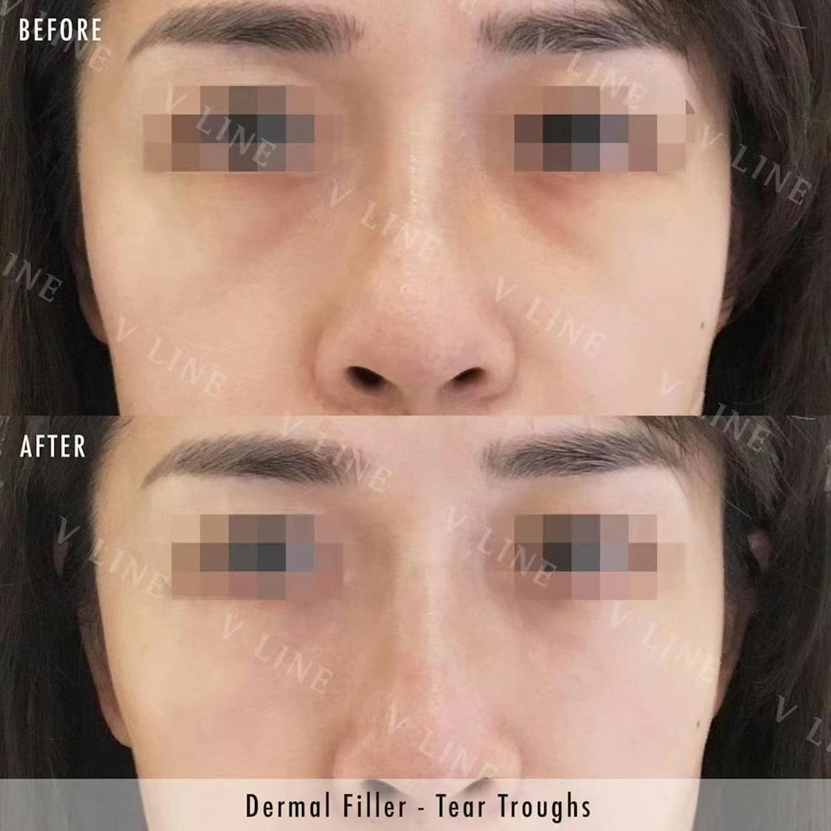 Dermal Fillers Before & After Gallery - Patient 133227500 - Image 1