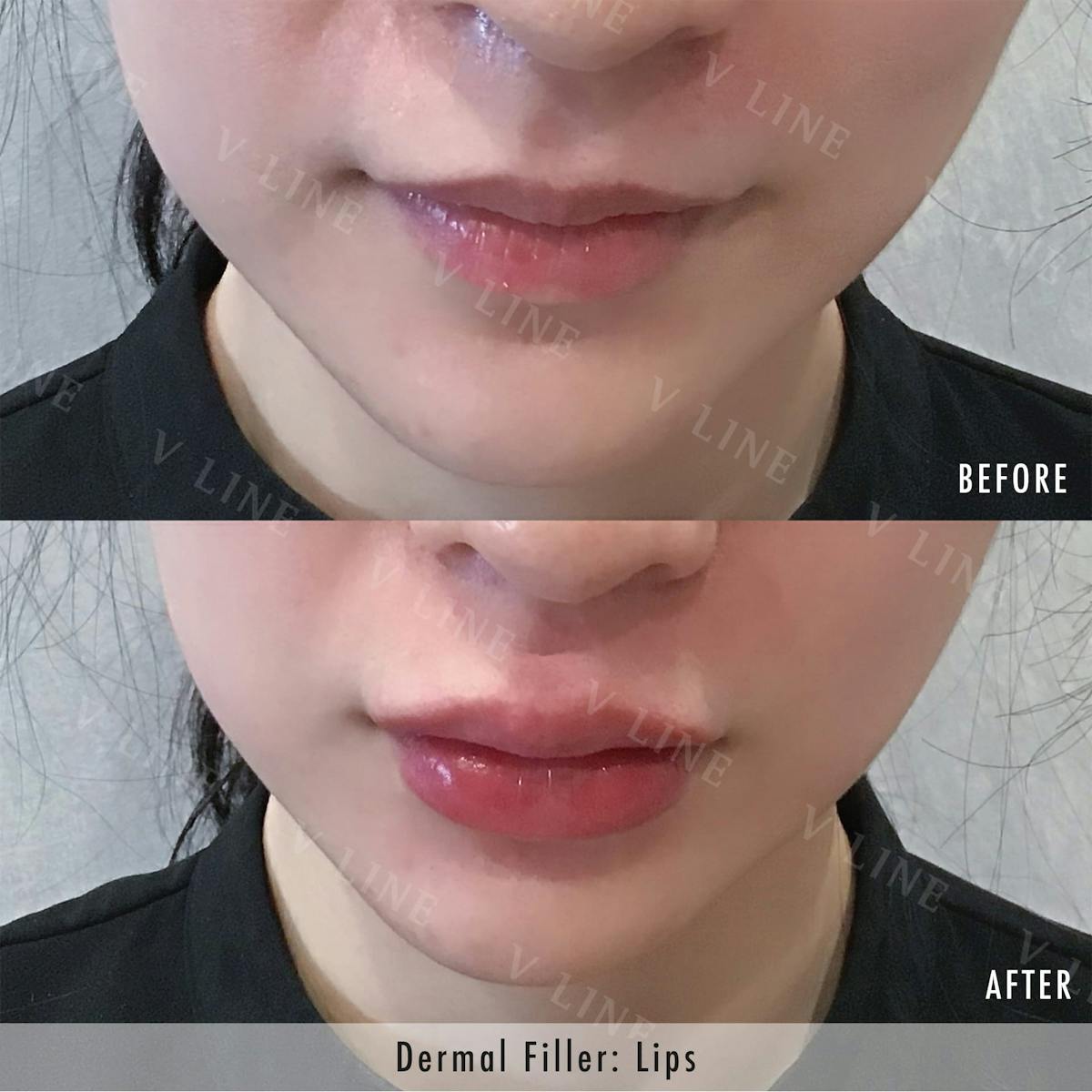 Dermal Fillers Before & After Gallery - Patient 133227512 - Image 1