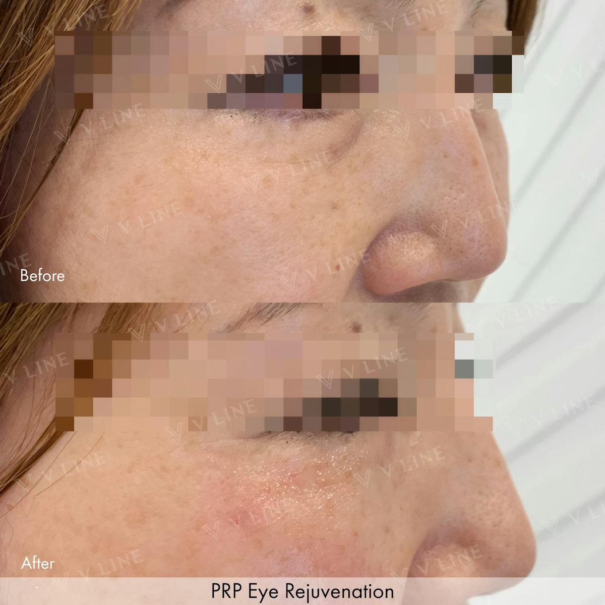 Platelet Rich Plasma Before & After Gallery - Patient 133235523 - Image 1