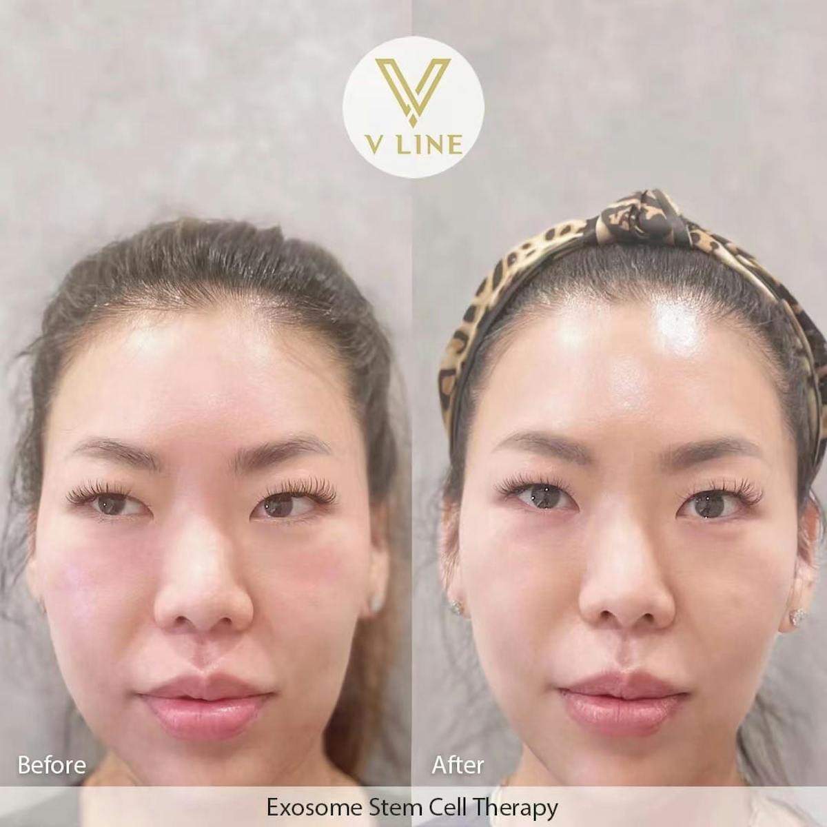 Exosome Therapy Before & After Gallery - Patient 133235922 - Image 1