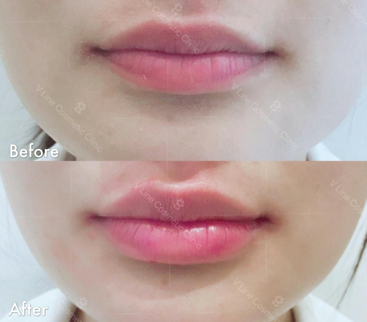 Dermal Fillers Before & After Gallery - Patient 133227521 - Image 1