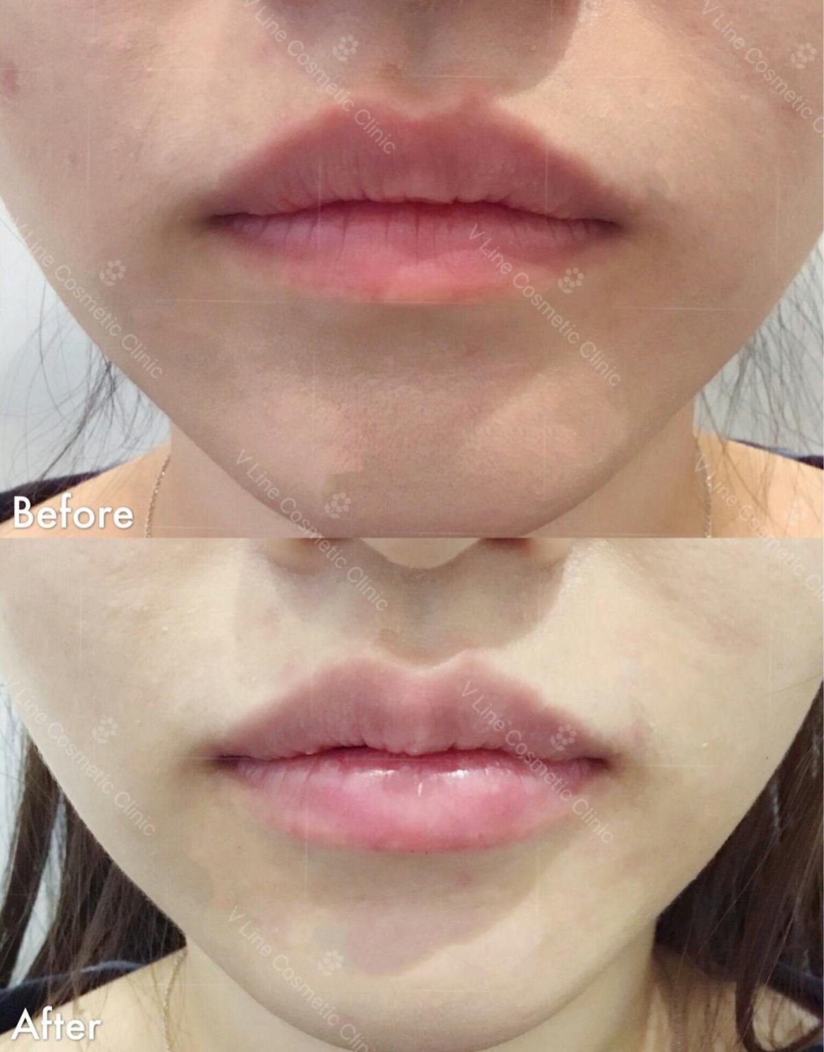 Dermal Fillers Before & After Gallery - Patient 133227520 - Image 1