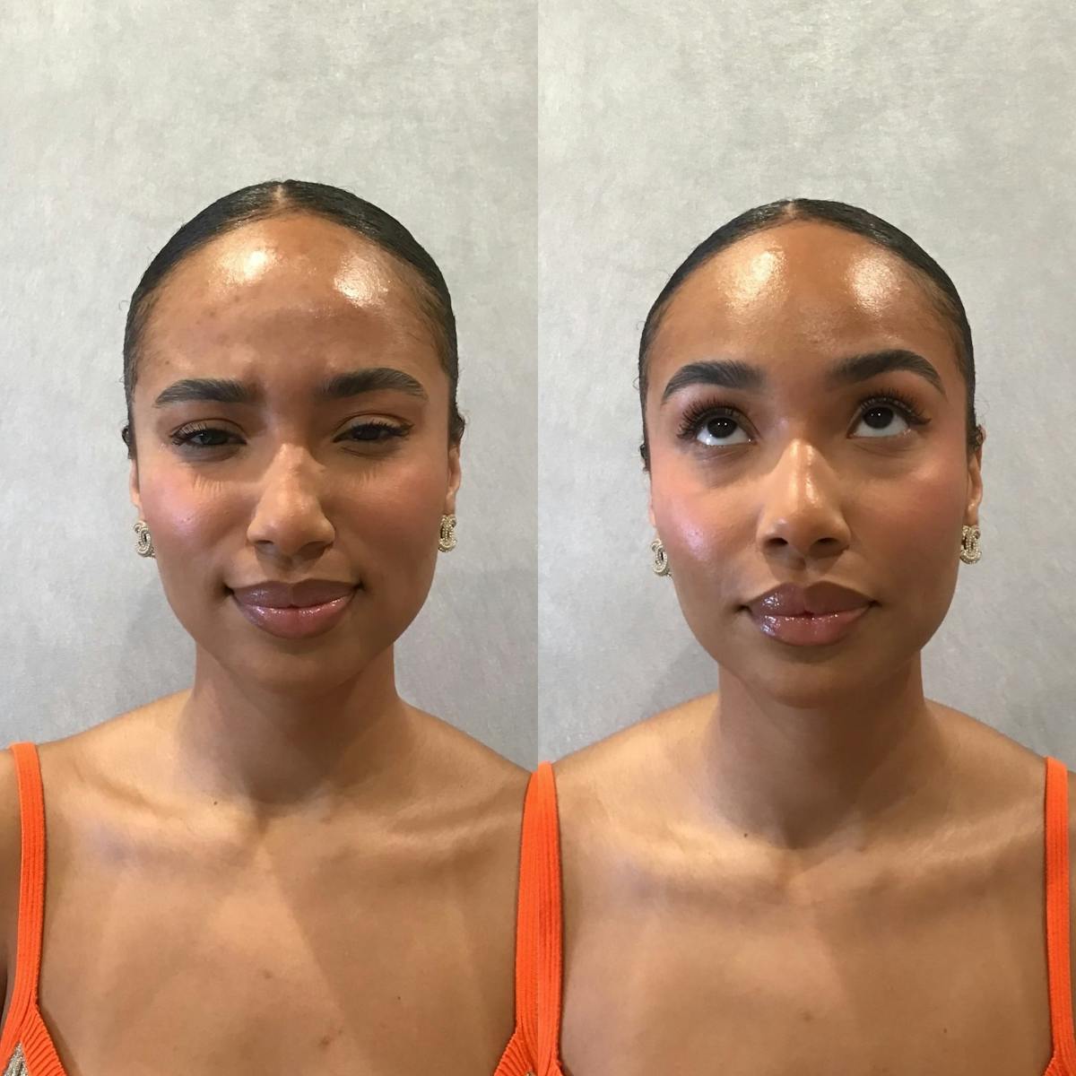 Wrinkle Relaxers Before & After Gallery - Patient 133235259 - Image 1