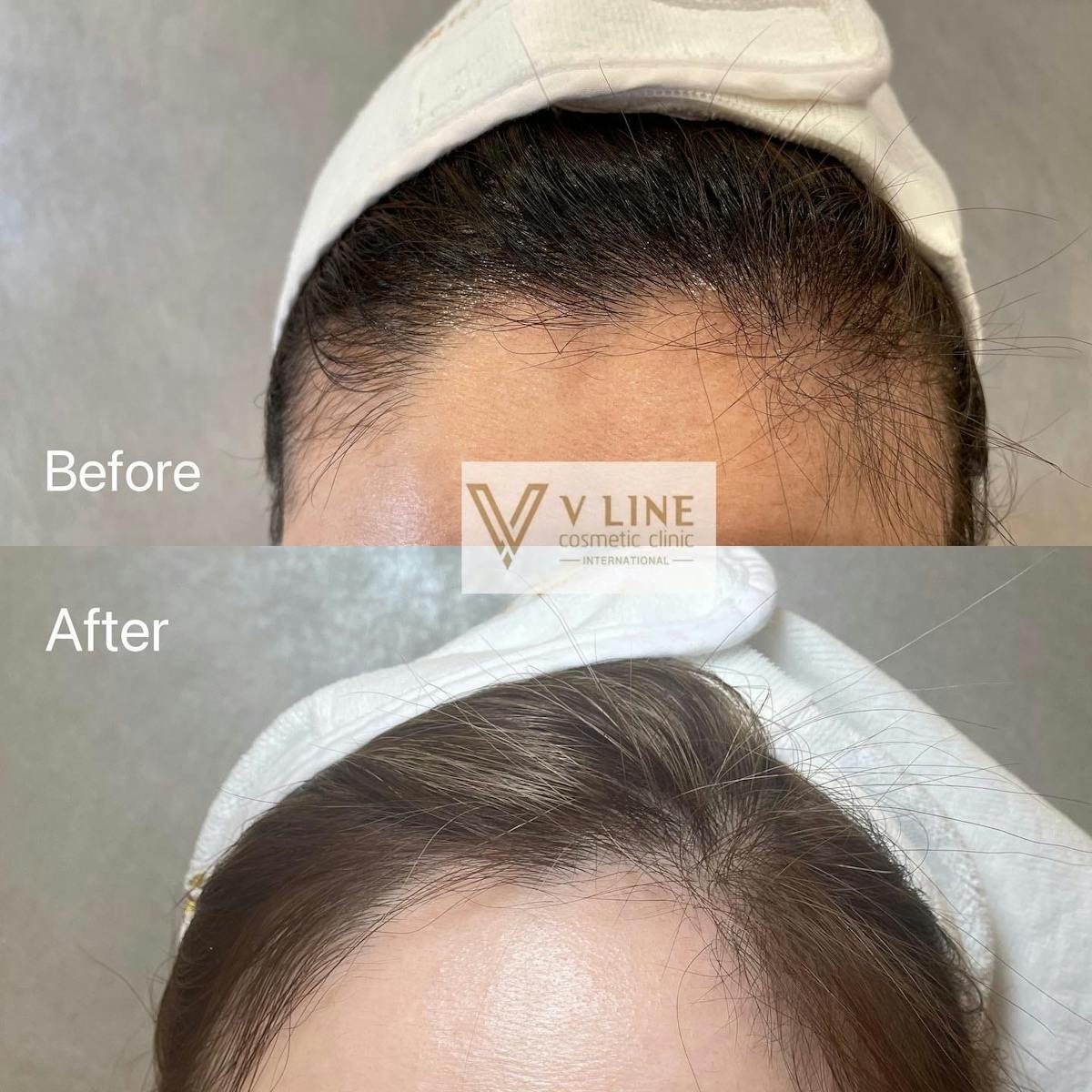Hair Treatment Before & After Gallery - Patient 133227648 - Image 3
