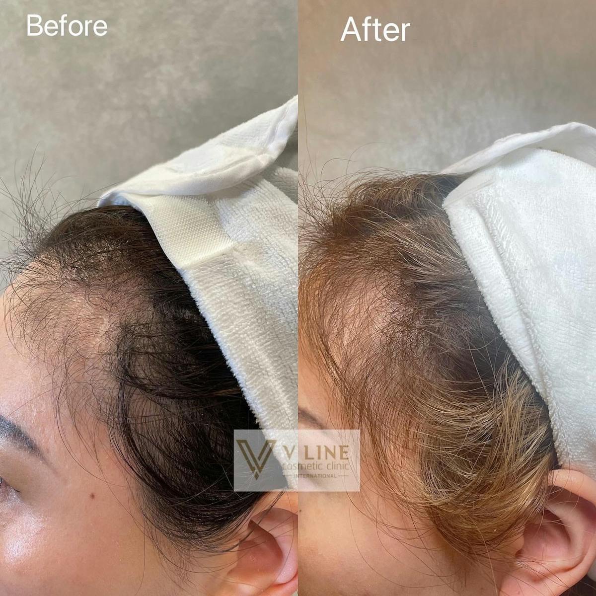 Hair Treatment Before & After Gallery - Patient 133227648 - Image 1