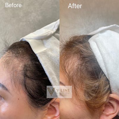 Hair Treatment Before & After Gallery - Patient 133227648 - Image 1