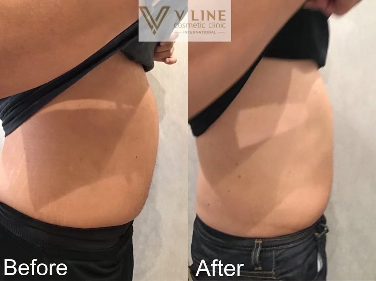 CoolSculpting Before & After Gallery - Patient 133227640 - Image 1
