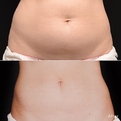 CoolSculpting Before & After Gallery - Patient 133227641 - Image 1