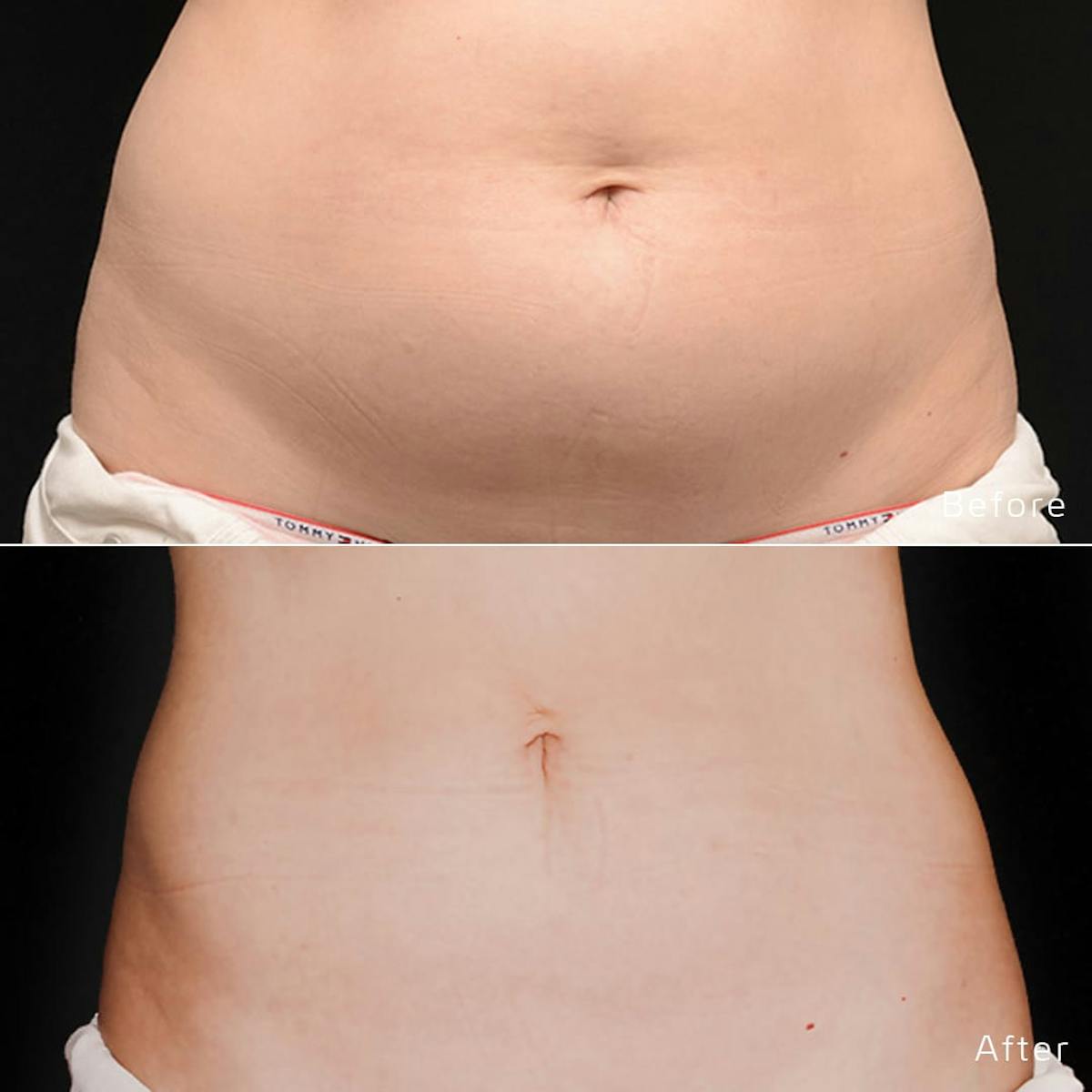 CoolSculpting Before & After Gallery - Patient 133227641 - Image 1