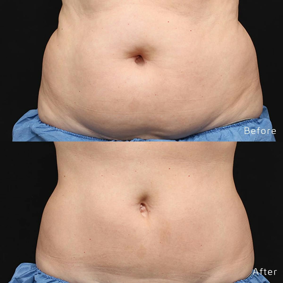 CoolSculpting Before & After Gallery - Patient 133227638 - Image 1