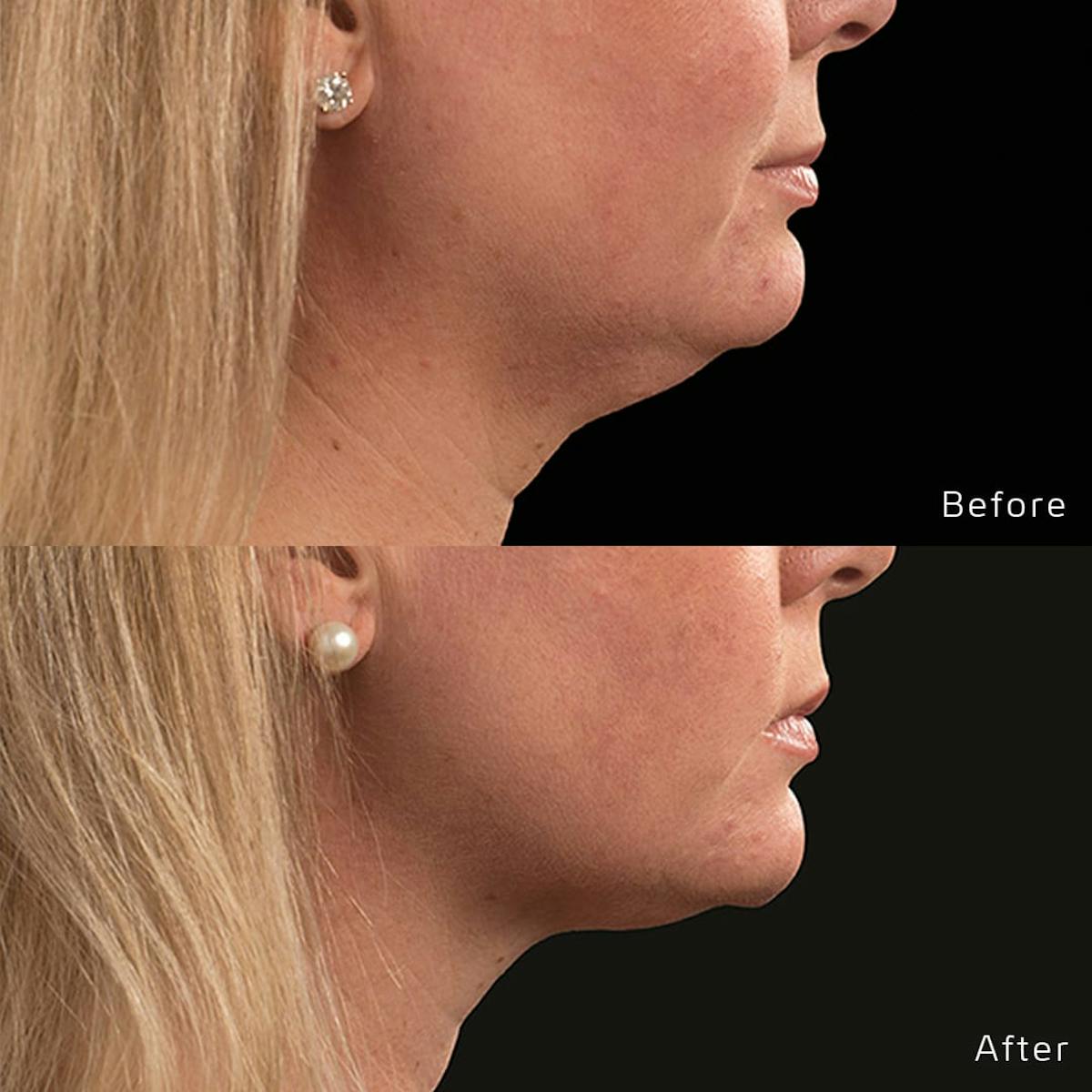 CoolSculpting Before & After Gallery - Patient 133227635 - Image 1