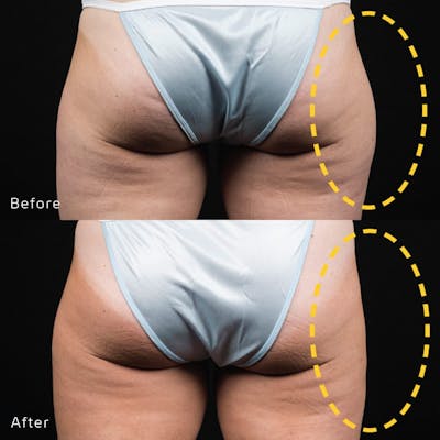CoolSculpting Before & After Gallery - Patient 133227636 - Image 1