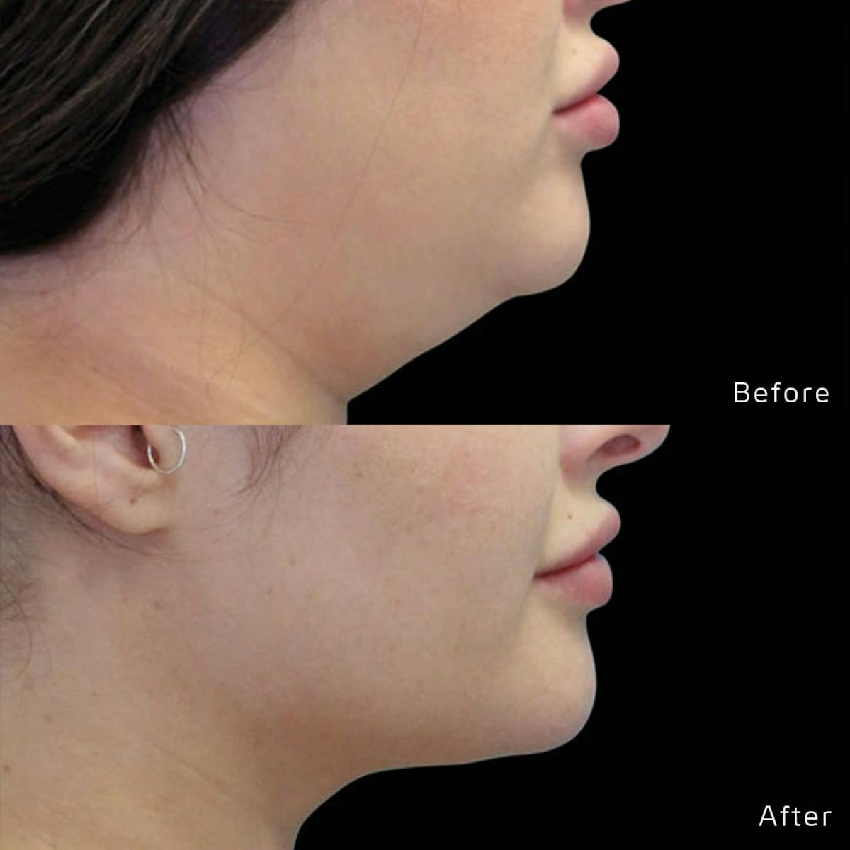 CoolSculpting Before & After Gallery - Patient 133227639 - Image 1
