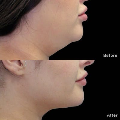 CoolSculpting Before & After Gallery - Patient 133227639 - Image 1