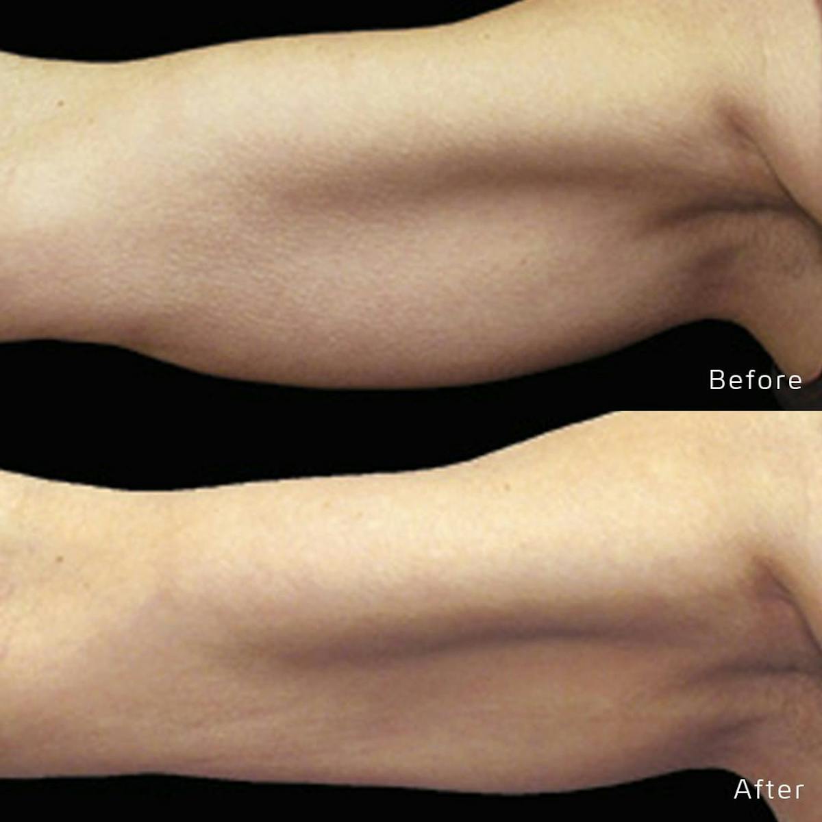 CoolSculpting Before & After Gallery - Patient 133227637 - Image 1