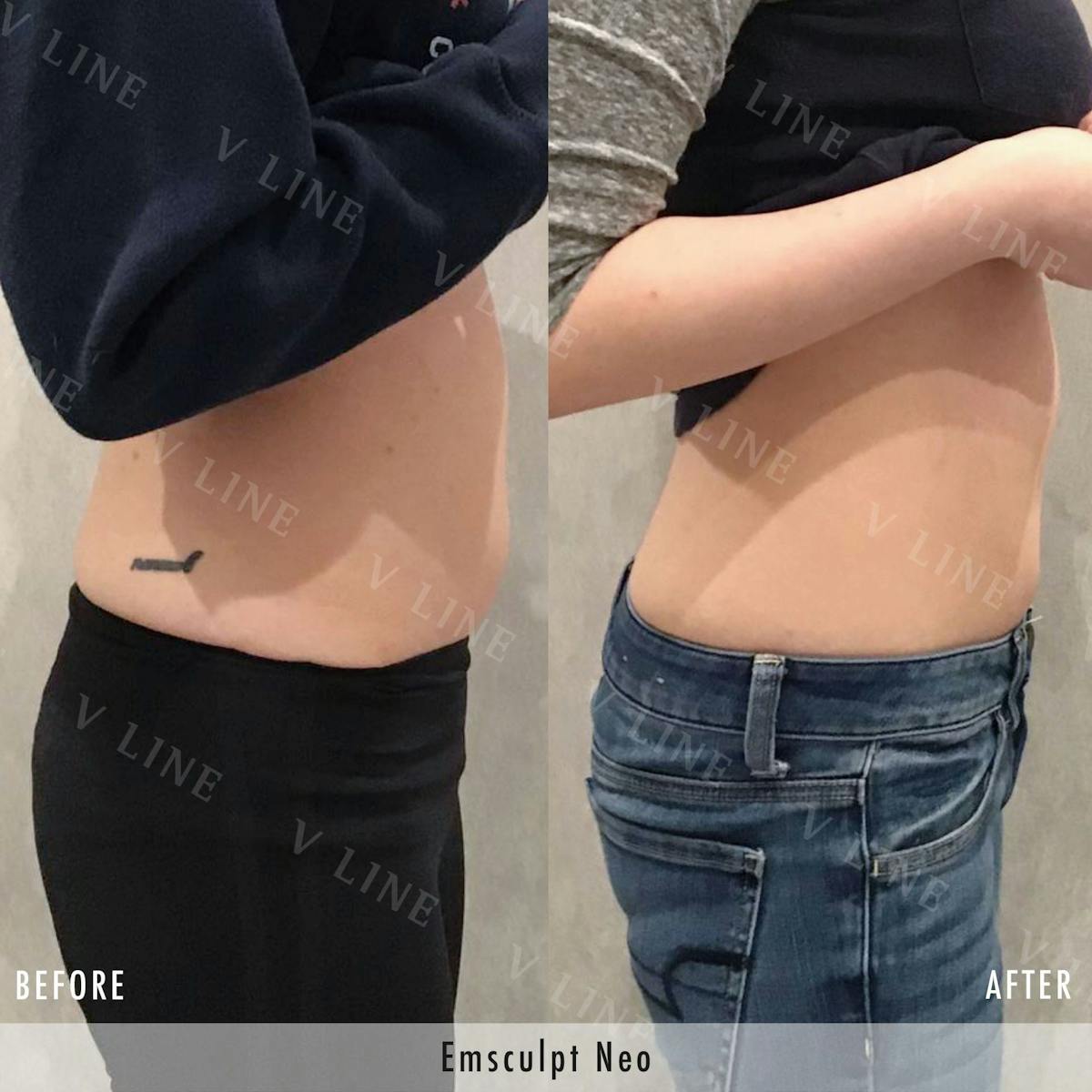 EmSculpt Before & After Gallery - Patient 133227568 - Image 2