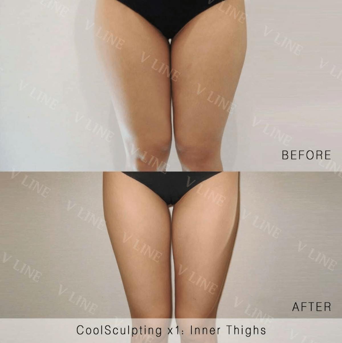 CoolSculpting Before & After Gallery - Patient 133236232 - Image 1