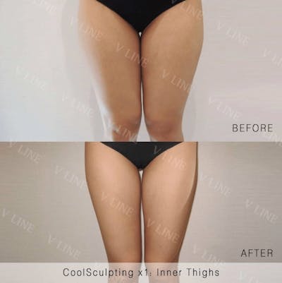 CoolSculpting Before & After Gallery - Patient 133236232 - Image 1