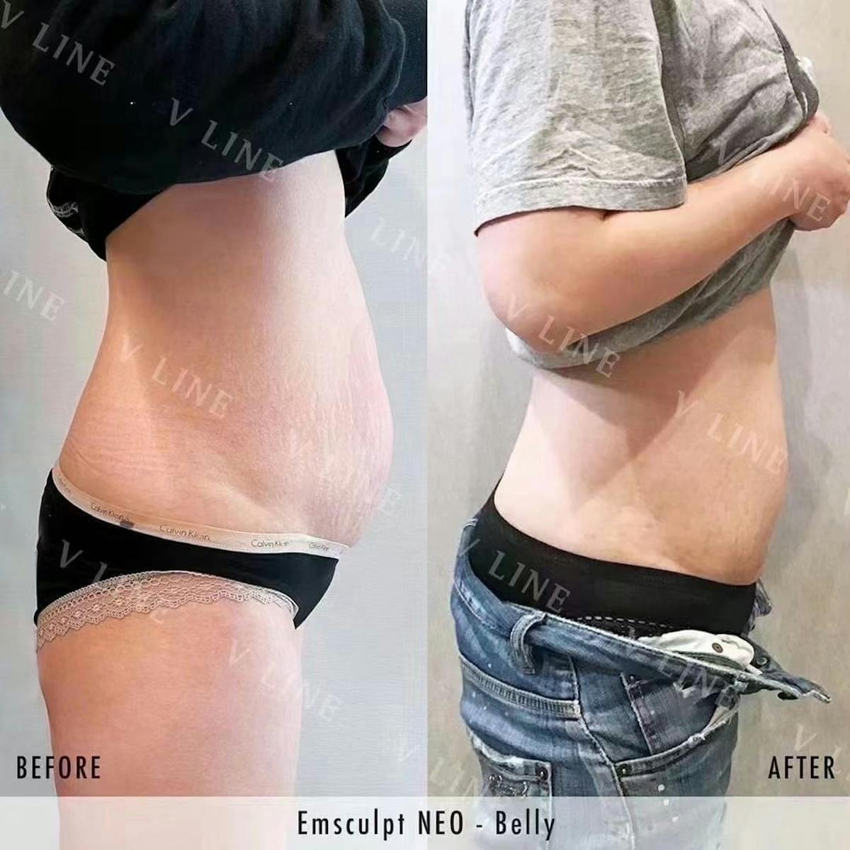 EmSculpt Before & After Gallery - Patient 133227566 - Image 1